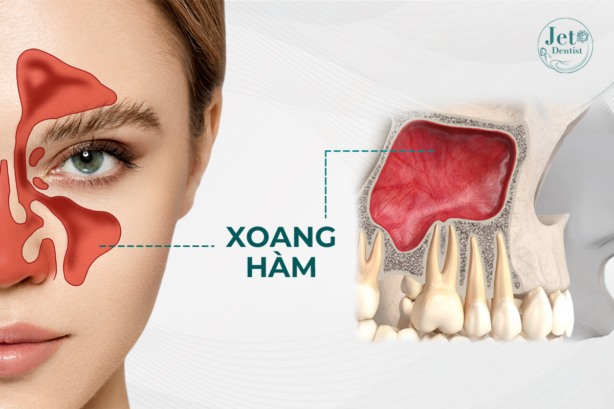 xoang hàm